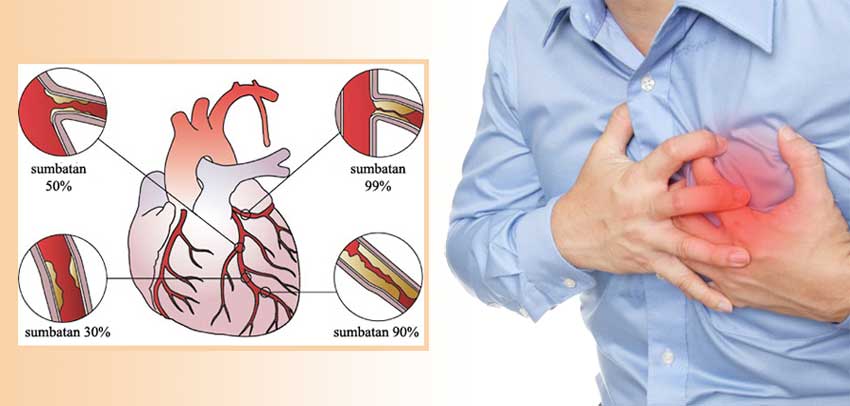 gejala penyakit jantung koroner surabaya
