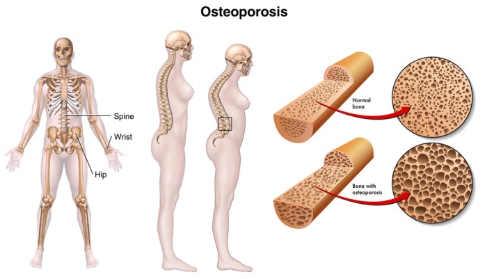jual obat Osteoporosis murah terbaik surabaya sidoarjo