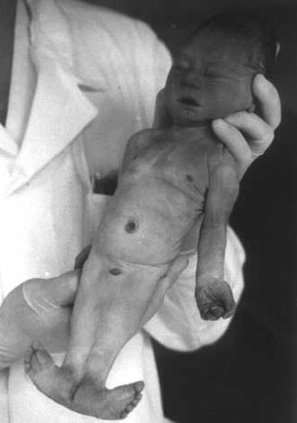 bayi lahir cacat terpapar radioaktif chernobyl